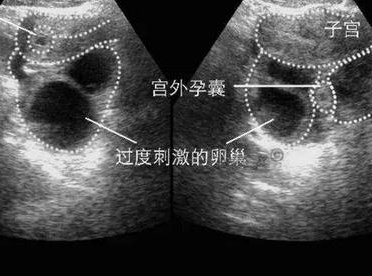 第三代试管婴儿适应人群，第一代试管婴儿适应人群